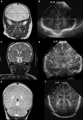 Assessment of brain two-dimensional metrics in infants born preterm at term equivalent age: Correlation of ultrasound scans with magnetic resonance imaging